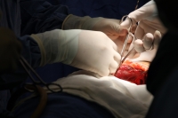 Jueves 2 de agosto del 2012. Tuxtla Gutiérrez, Chiapas. El 11avo trasplante de riñón se llevó a cabo esta mañana en el Hospital de Especialidades Pediátricas de Chiapas. El órgano fue donado por el padre del menor quien padece una enfermedad crónica.